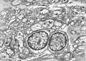 M, 58y. | neurofibroma